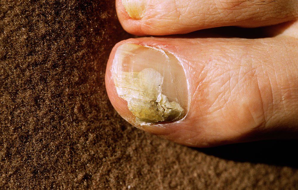 6 Effective Natural Remedies for Treating Nail Fungus