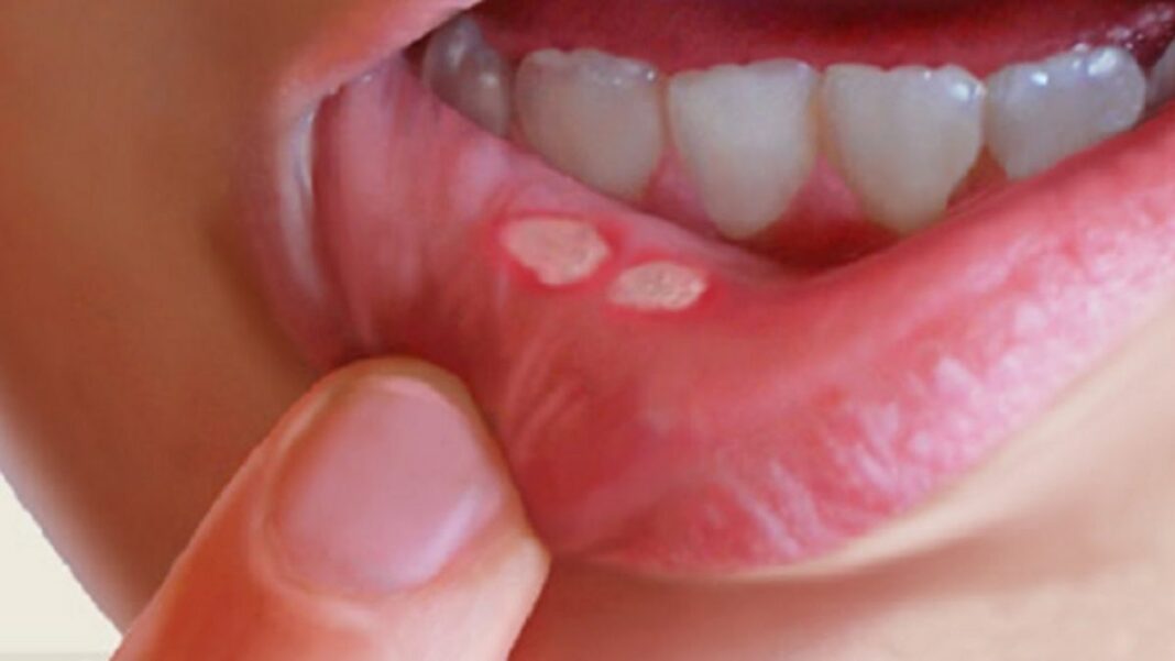 Banish the Pain: The Ultimate Guide to Mouth Ulcers - Causes, Remedies & Prevention