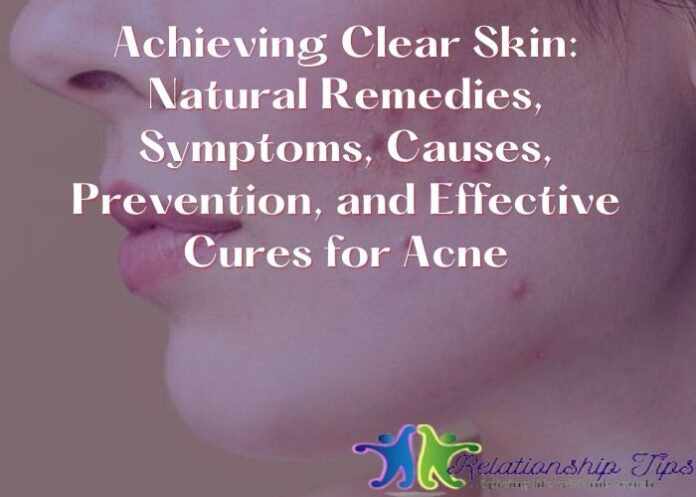 Achieving Clear Skin: Natural Remedies, Symptoms, Causes, Prevention, and Effective Cures for Acne