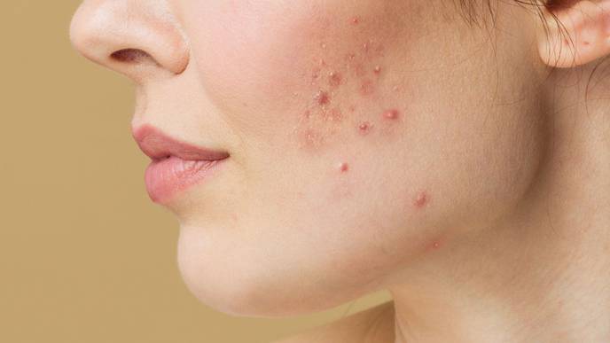 Unlocking Clear Skin: Your Comprehensive Guide to Understanding and Treating Acne